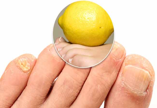 1-clean-yellow-toe-nails-pr
