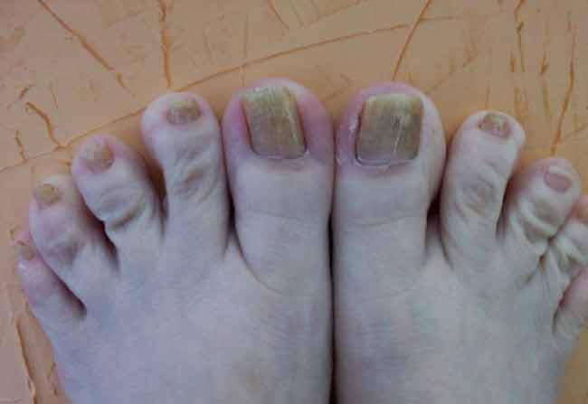 clean yellow toe nails prcedure