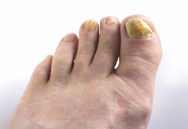 how to get rid of yellow toenails sitting at the comfort of your home