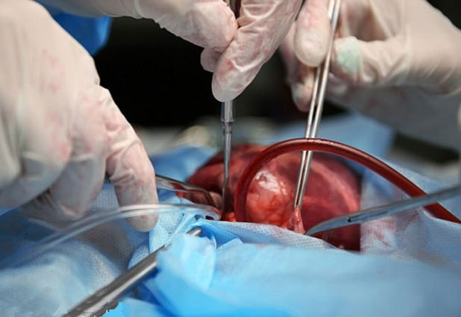 doctors bring a dead heart back to life using pioneering box saves man’s life