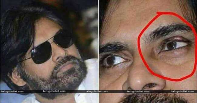 janasenani underwent second eye surgery