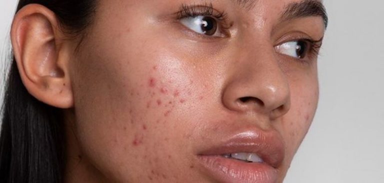 Stress, poor diet, linked with acne