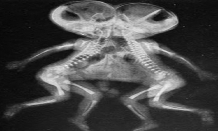 1st in KGMU: Siamese twins separated