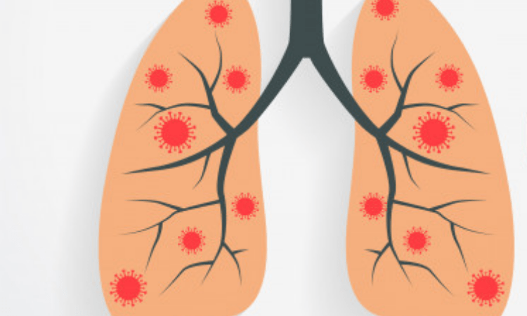 Researchers develop new treatment for lung fibrosis