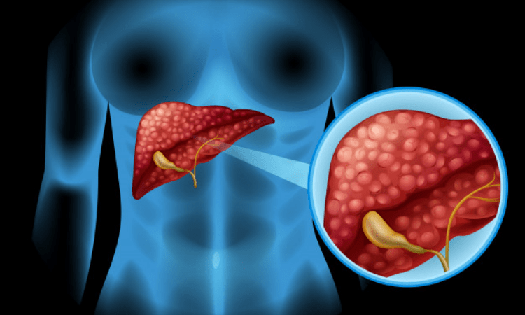 CT helps catch high-risk nonalcoholic fatty liver disease