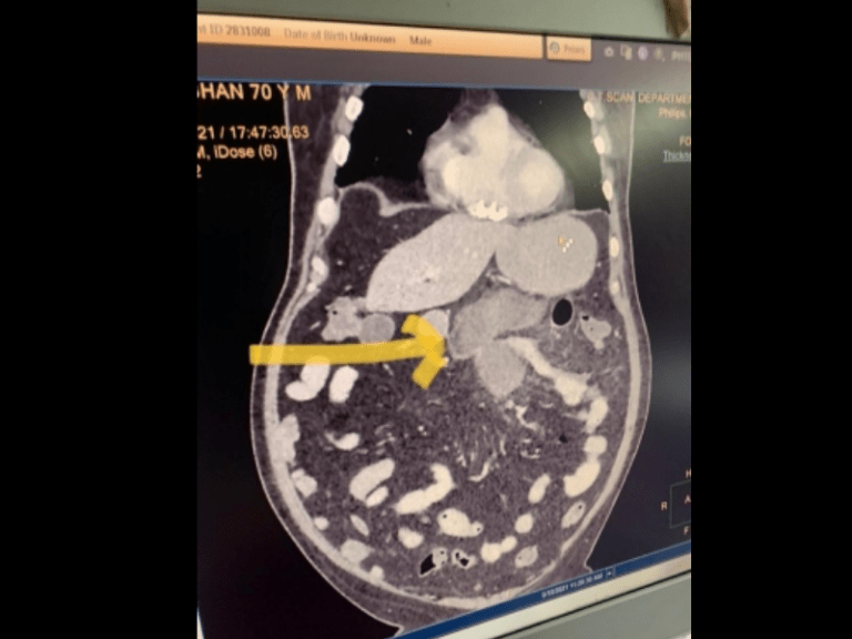 Black fungus of intestine: Novel complication diagnosed in Covid patients in Delhi