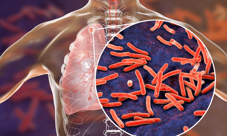 Aerosols spread tuberculosis like Covid-19: Study