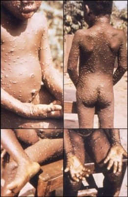Monkeypox spreads to more than 20 countries: WHO