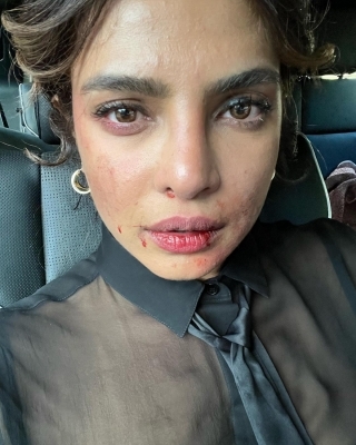 Priyanka Chopra shares picture of ‘bruised’ face from ‘Citadel’ set