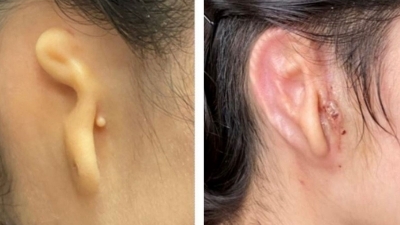 Woman implanted with 3D-printed ear made from her own cells