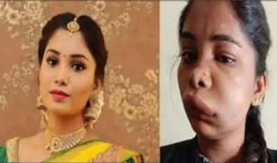 Kannada actress Swathi’s face gets horribly swollen after root canal op goes wrong