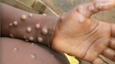 TN to isolate int’l travellers with monkeypox symptoms
