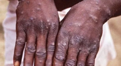 Suspected case of monkeypox in Kerala, sample sent for testing
